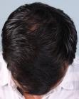 After Hair Transplant&nbsp;Front